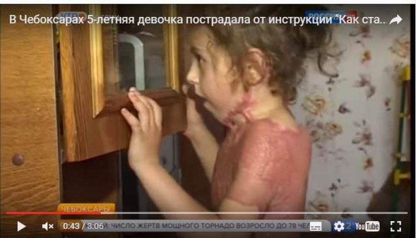 Пострадавшую от инструкции «Как стать феей огня» девочку показали на ТВ (ВИДЕО)